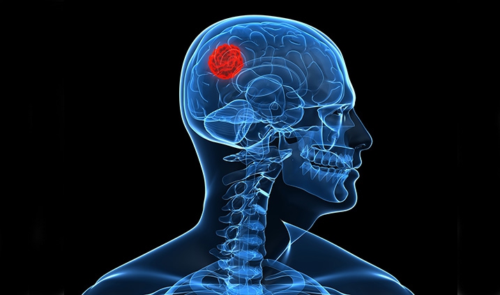 cáncer de cerebro detectado