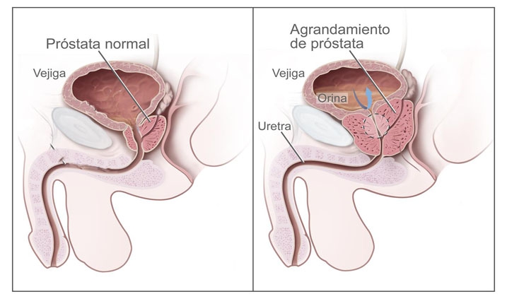 Situación de cáncer de próstata